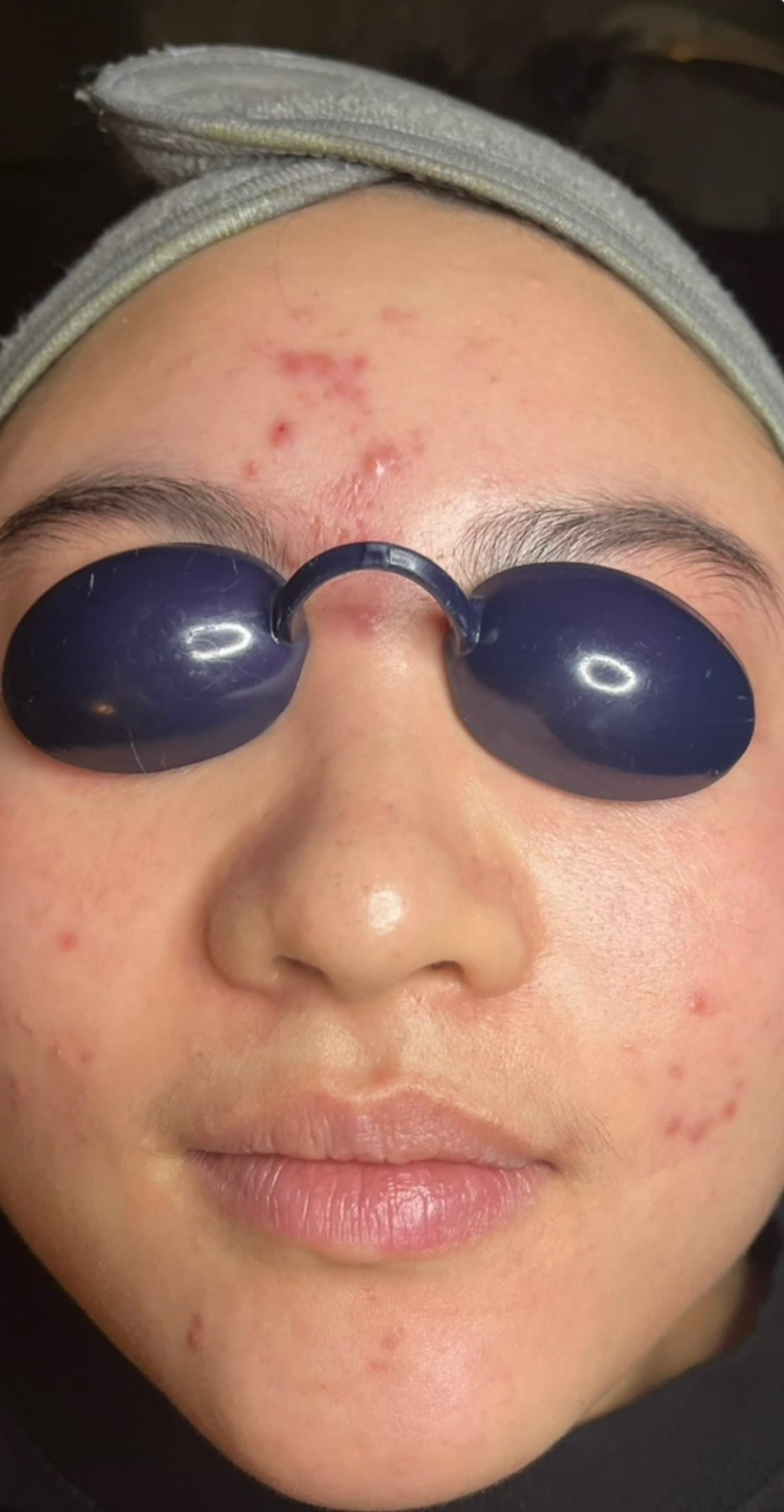 Before photo for an acne result over 3 months.