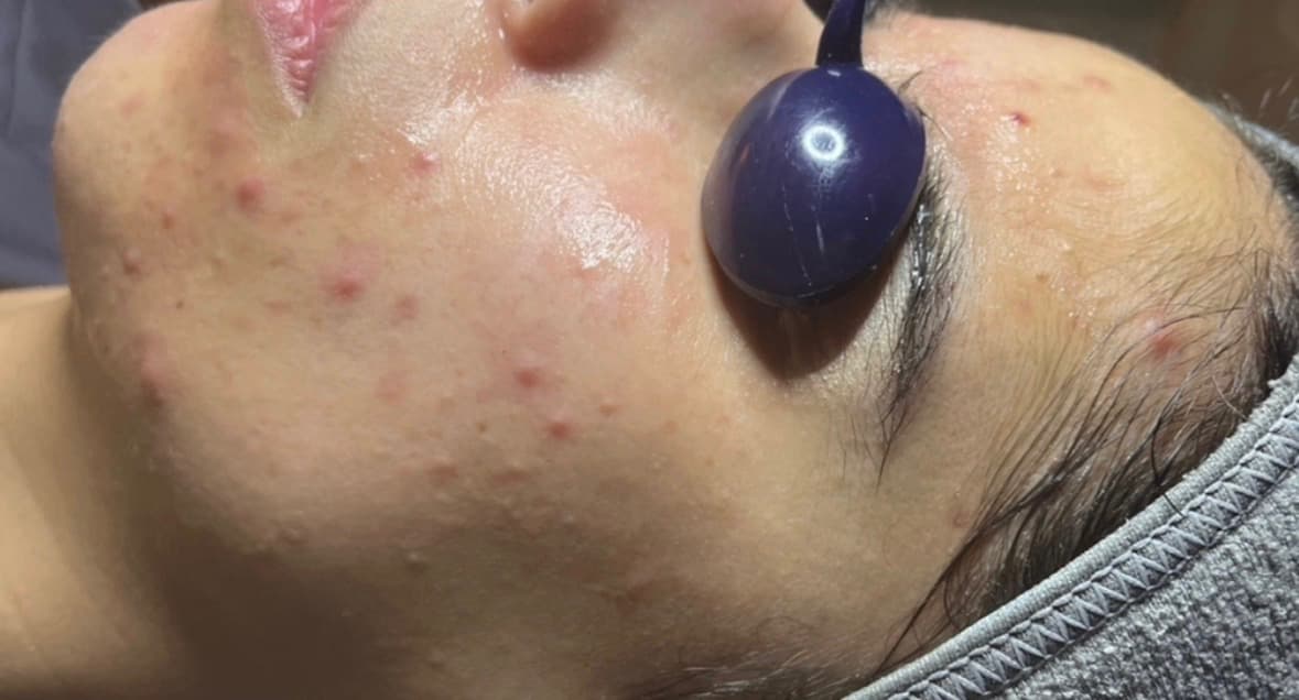 Before photo for an acne result over 5 months.