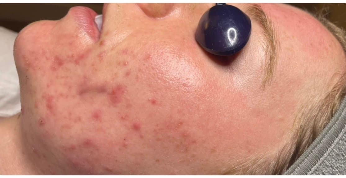 Before photo for acne, scarring, divot correction, and redness.
