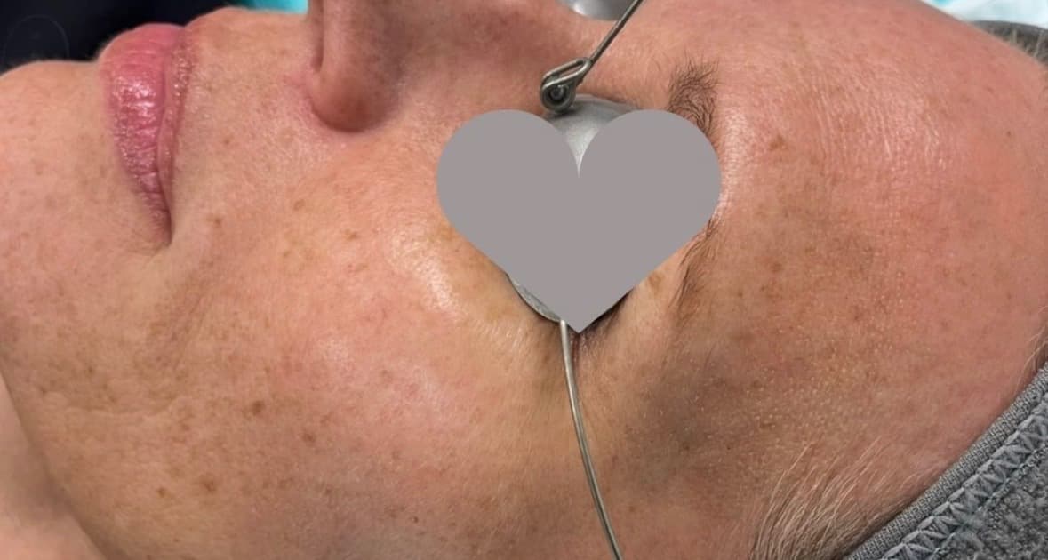 Before photo for BBL and microneedling over 3 months.