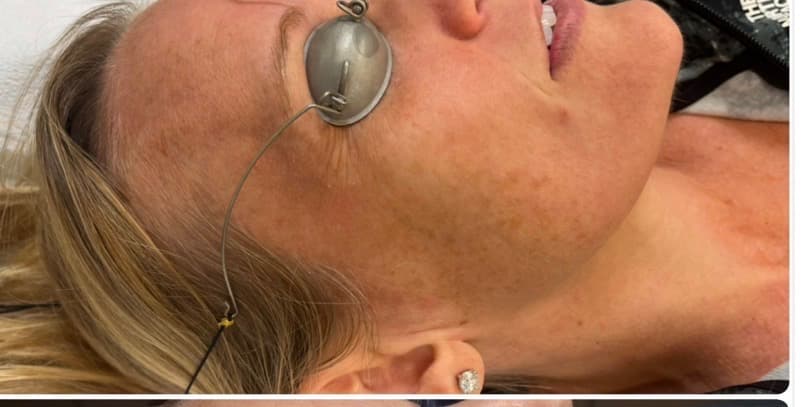 Before photo for BBL and microneedling over 5 months.
