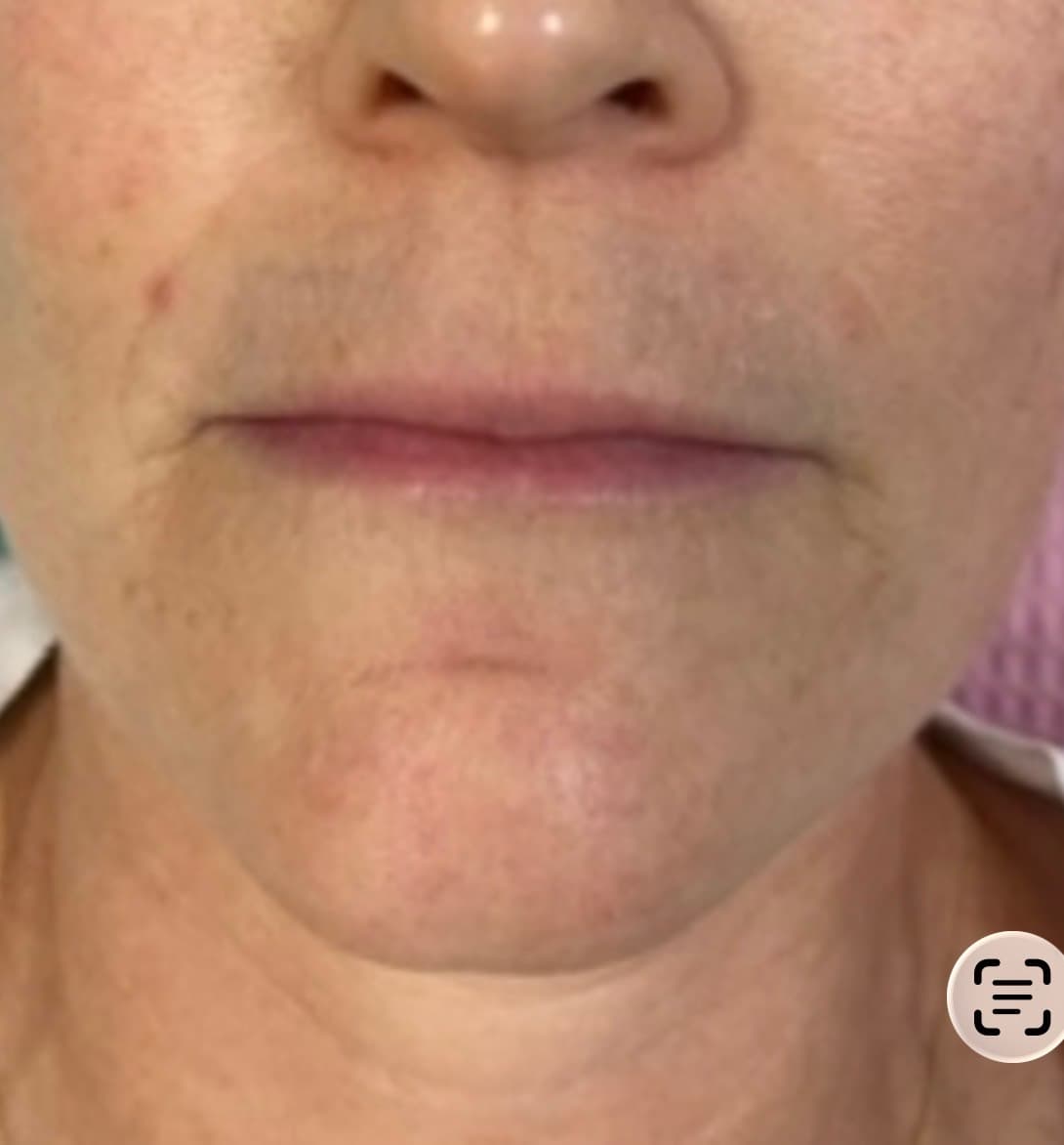 Before photo for BBL and resurfacing at the same appointment.