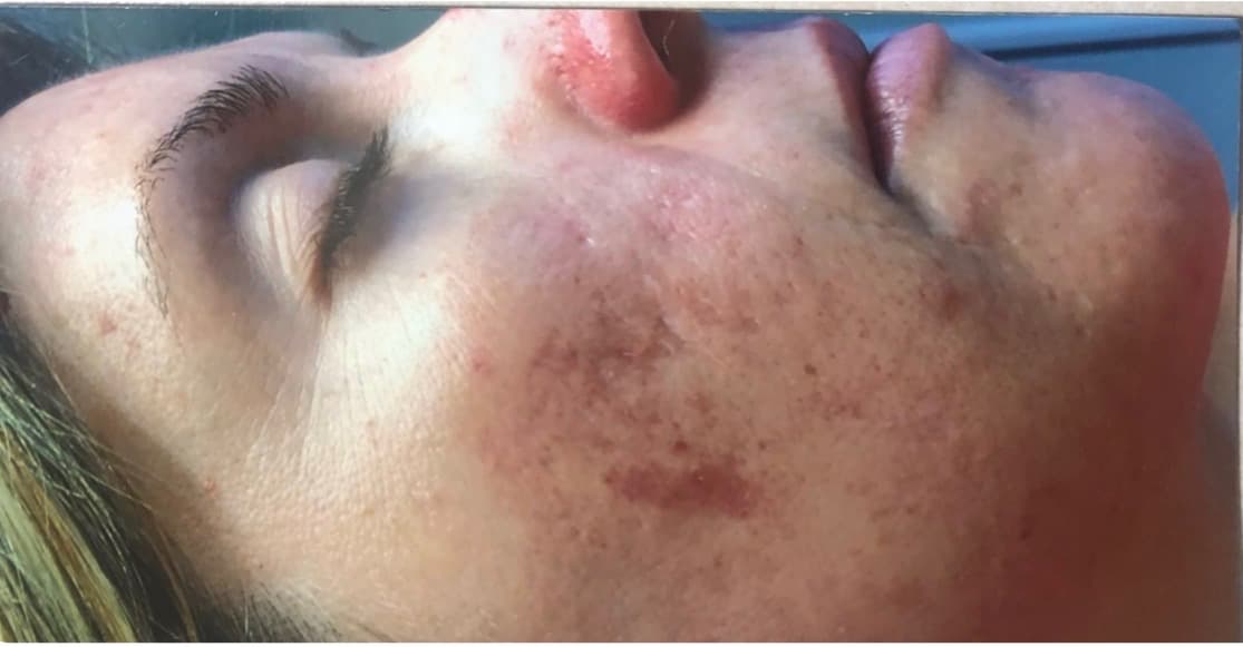 Day 1 photo for the same microneedling and peels client.