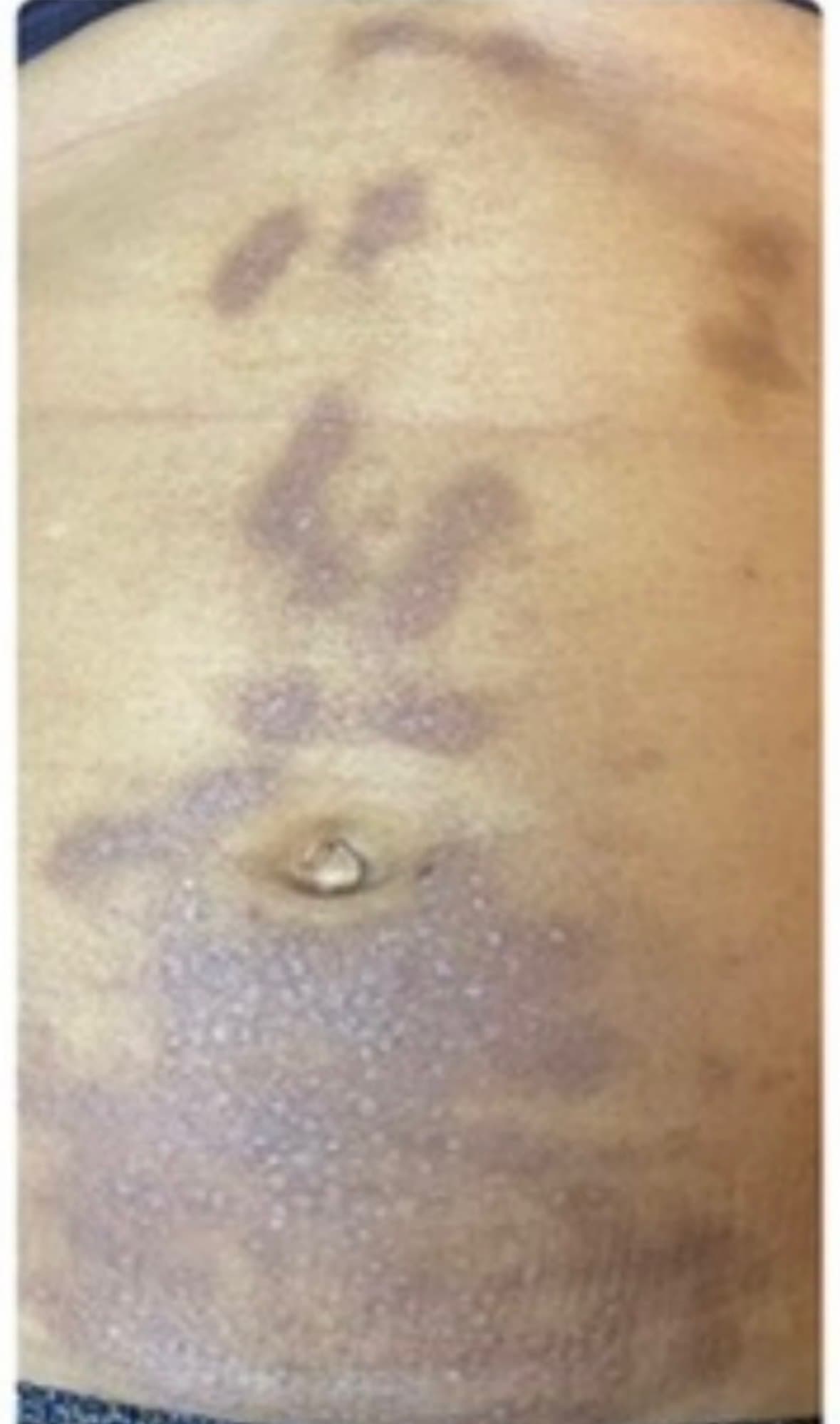 Before photo for post-inflammatory hyperpigmentation treated with a chemical peel.